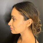 Rhinoplasty Before & After Patient #9329