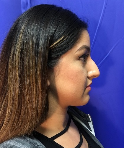 Rhinoplasty Before & After Patient #9373