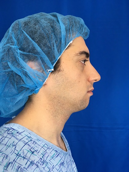 Rhinoplasty Before & After Patient #9382