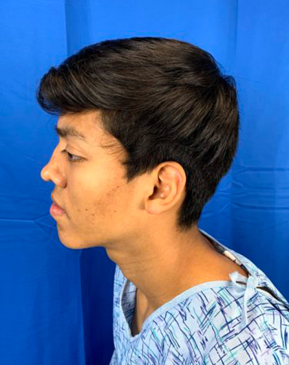 Rhinoplasty Before & After Patient #9394
