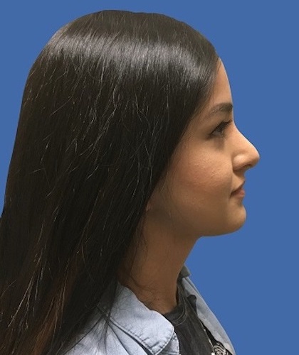 Rhinoplasty Before & After Patient #9373