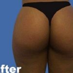 Brazilian Butt Lift Before & After Patient #9346