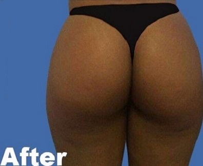 Brazilian Butt Lift Before & After Patient #9346