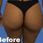 Brazilian Butt Lift Before & After Patient #9346