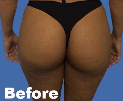 Patient #9346 Brazilian Butt Lift Before and After Photos Beverly