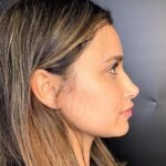 Rhinoplasty Before & After Patient #9329