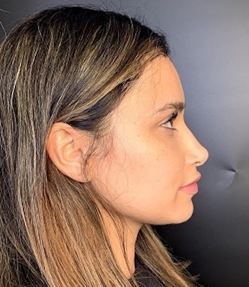 Rhinoplasty Before & After Patient #9329