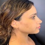 Rhinoplasty Before & After Patient #9329