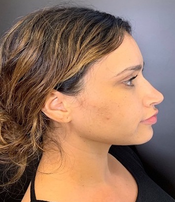 Rhinoplasty Before & After Patient #9329