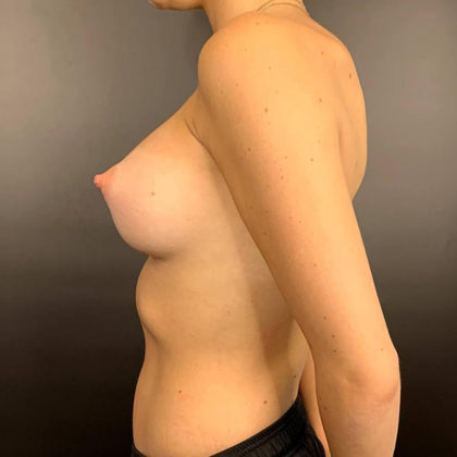 Breast Augmentation Before & After Patient #9370