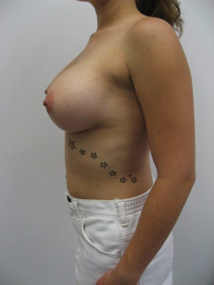 Breast Augmentation Before & After Patient #9493