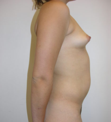 Breast Augmentation Before & After Patient #9493