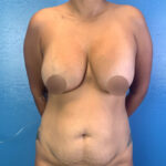Tummy Tuck Before & After Patient #9463