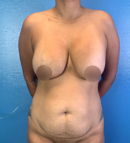 Tummy Tuck Before & After Patient #9463