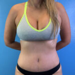 Tummy Tuck Before & After Patient #9463