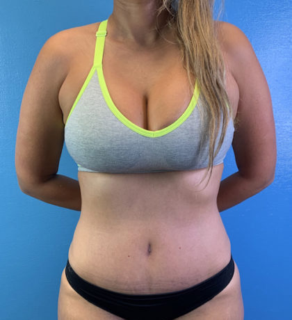 Tummy Tuck Before & After Patient #9463