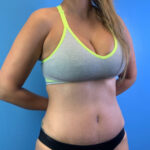 Tummy Tuck Before & After Patient #9463