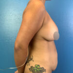 Tummy Tuck Before & After Patient #9463