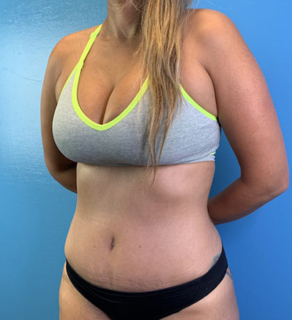 Tummy Tuck Before & After Patient #9463