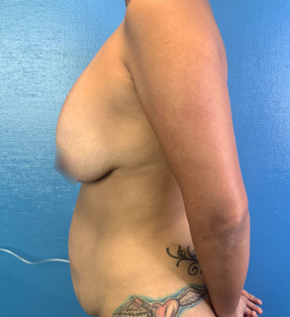 Tummy Tuck Before & After Patient #9463