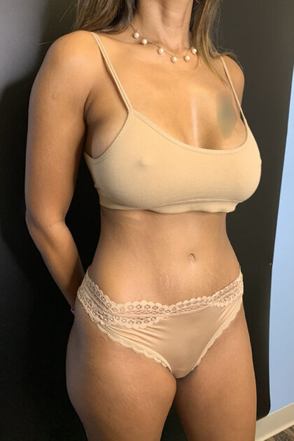 Tummy Tuck Before & After Patient #9759