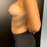 Breast Augmentation Before & After Patient #9807