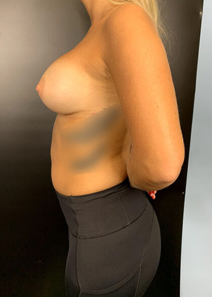 Breast Augmentation Before & After Patient #9807
