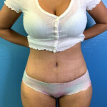 Tummy Tuck Before & After Patient #9781