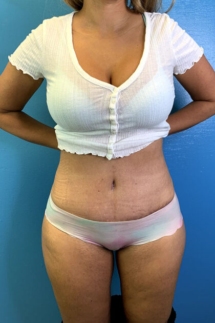 Tummy Tuck Before & After Patient #9781