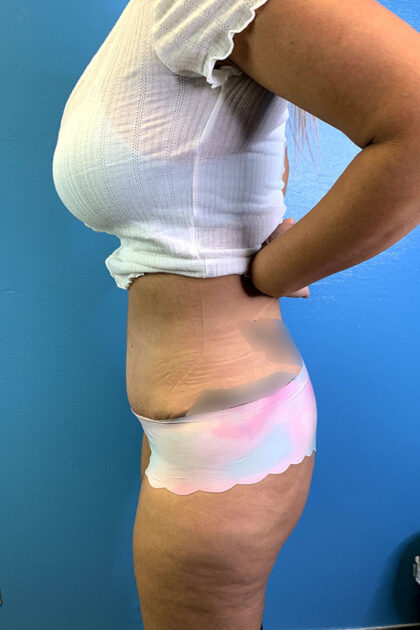 Tummy Tuck Before & After Patient #9781
