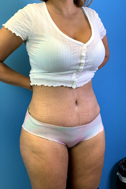 Tummy Tuck Before & After Patient #9781