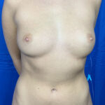 Liposuction Before & After Patient #9794