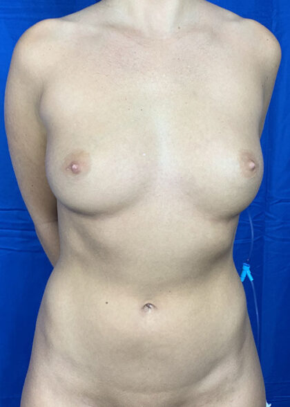 Liposuction Before & After Patient #9794