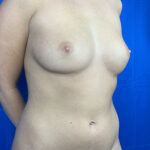 Liposuction Before & After Patient #9794