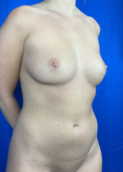 Liposuction Before & After Patient #9794