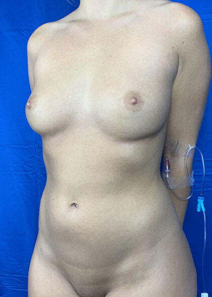 Liposuction Before & After Patient #9794