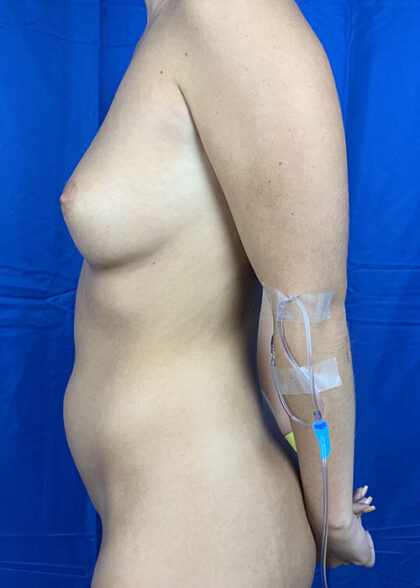 Liposuction Before & After Patient #9794