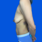 Breast Lift / Mannequin Breast Lift Before & After Patient #9826