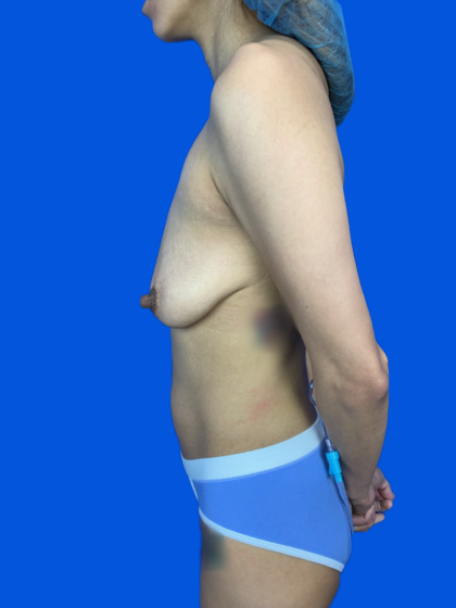 Breast Lift / Mannequin Breast Lift Before & After Patient #9826