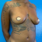 Breast Augmentation Before & After Patient #9846