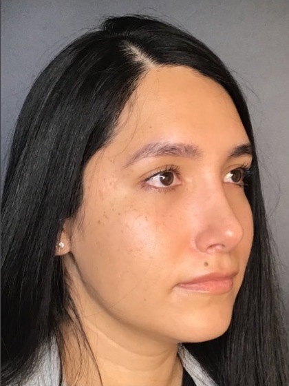 Rhinoplasty Before & After Patient #9873