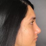 Rhinoplasty Before & After Patient #9873