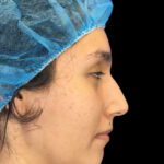 Rhinoplasty Before & After Patient #9873