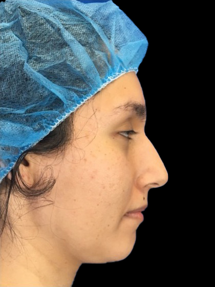 Rhinoplasty Before & After Patient #9873