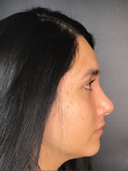 Rhinoplasty Before & After Patient #9873