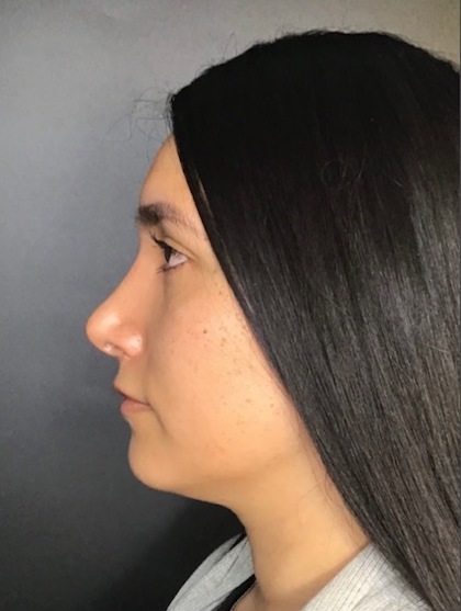 Rhinoplasty Before & After Patient #9873