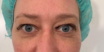 Blepharoplasty Before & After Patient #10025