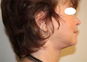 Facelift and Necklift Before & After Patient #10051