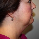 Facelift and Necklift Before & After Patient #10028