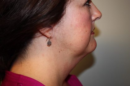 Facelift and Necklift Before & After Patient #10028